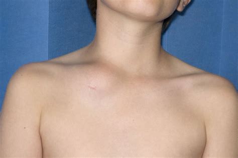 Clavicular swelling—classic presentation of chronic non-bacterial osteomyelitis | Archives of ...