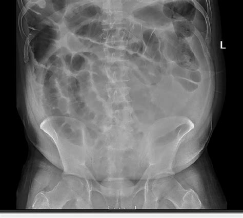 Abdominal X-ray showed diffuse ileus. | Download Scientific Diagram