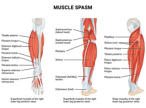 Muscle Spasm (Muscle Cramps) Treatment - Physical Therapists NYC