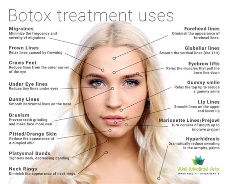 Botox Brow Lift Botox Injection Sites Diagram - alternator