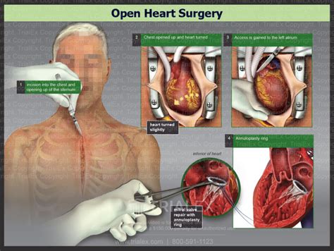 Open Heart Surgery - TrialQuest Inc.