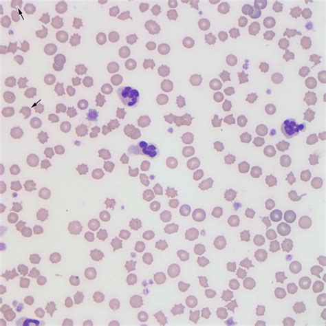 keratocyte – eClinpath