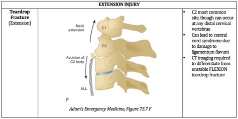 Unstable Cervical Spine Fractures The Common Mnemonic Grepmed | Hot Sex ...