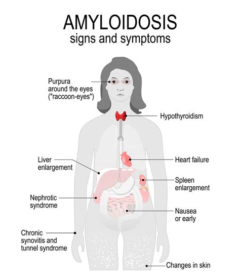 Primary Amyloidosis : Overview, Causes, Symptoms, Treatment - illness.com