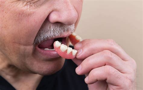 What to expect when having new dentures fitted