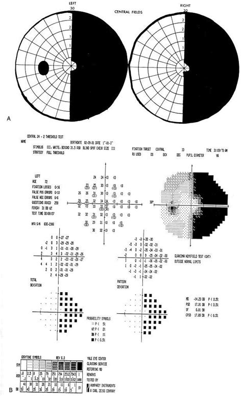 154 best Hemianopsia images on Pinterest | Texts, Fields and Diff'rent strokes