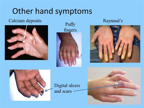 Scleroderma: Types, Symptoms & Treatment » How To Relief