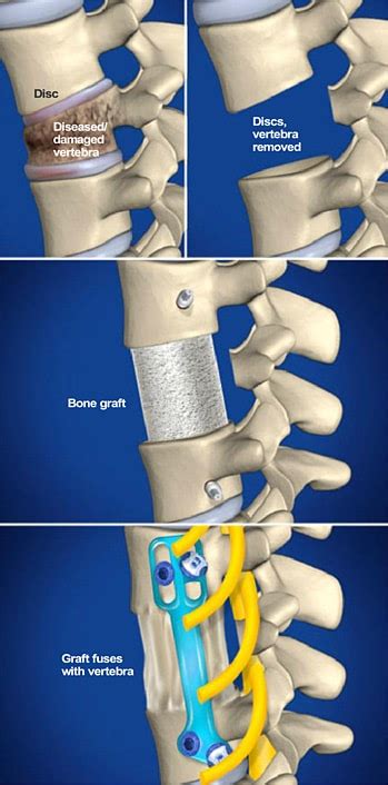 Lumbar Corpectomy - The Southeastern Spine Institute