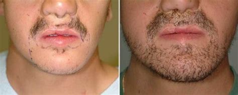 Implante de barba: Funciona? Saiba o preço e os resultados!