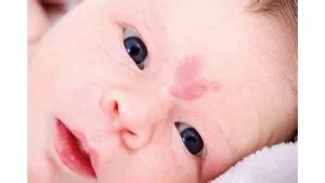 Understanding Stork Bite Birthmarks: Causes, Treatment, and Management ...