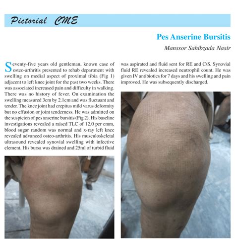 Pes Anserine Bursitis Diagram