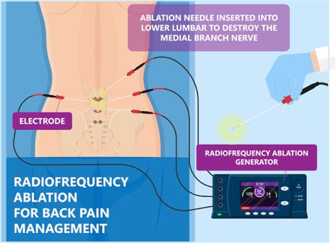 Radiofrequency Ablation | AllSpine Laser & Surgery Centers