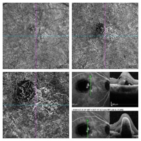 OCT Angiography Comes to Hawaii - Hawaii Macula and Retina InstituteHawaii Macula and Retina ...