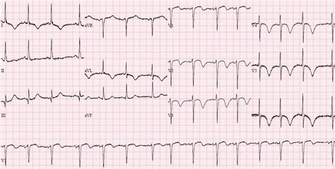 New-onset giant T-wave inversion with prolonged QT interval: shared by ...