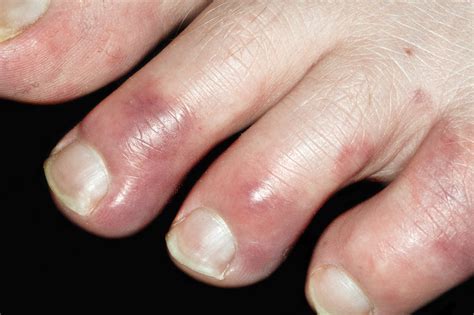 Chilblains - NHS