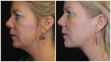 Say Goodbye to Your Double Chin! | Kybella in Denver & Broomfield