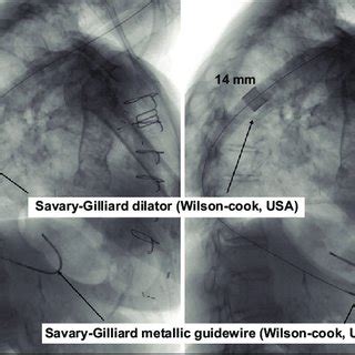 Fluoroscopy showing Savary-Gilliard dilation procedure | Download Scientific Diagram