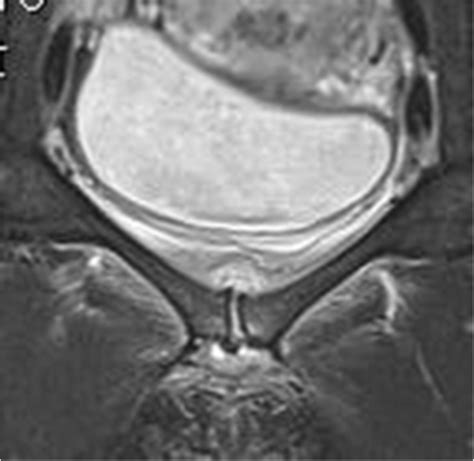 MRI showing oedema of the symphysis protruding both cranio-dorsally ...