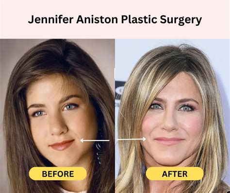 Jennifer Aniston Plastic Surgery Secrets : Before And After Photos | Fabbon