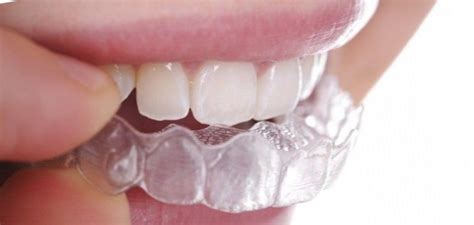 Invisible Braces - Affordable Dentist Sydney