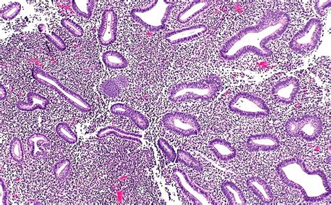 Disordered proliferative endometrium | MyPathologyReport.ca