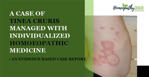 A Case of Tinea Cruris Managed with Individualized Homoeopathic Medicine: An Evidence Based Case ...