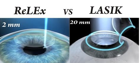 ReLEx Smile Eye Surgery in Delhi: Best Doctors, Cost & Hospital