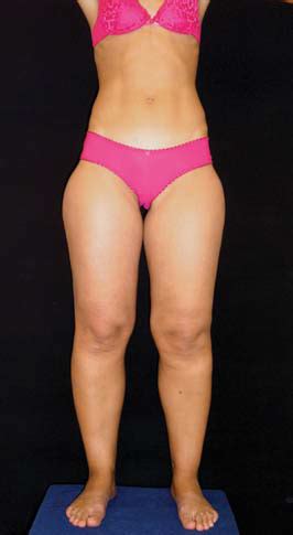 What is Lipedema? - Laser Lipo & Vein Center