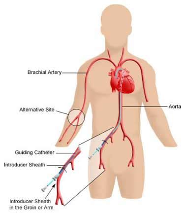 Cardiac catheterisation