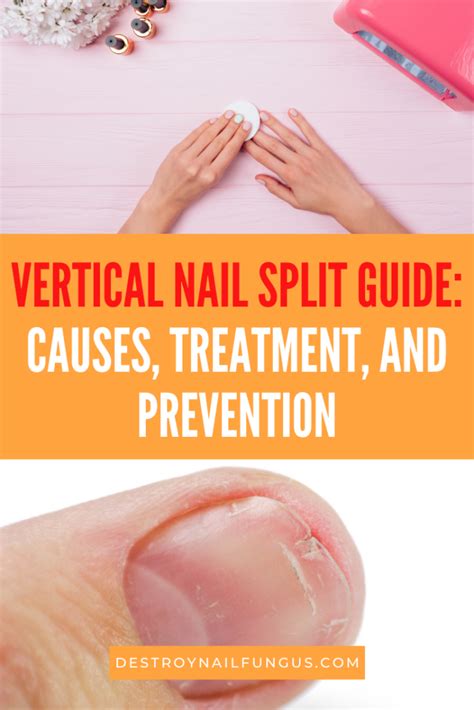 How To Fix A Vertical Nail Split: A Comprehensive Guide