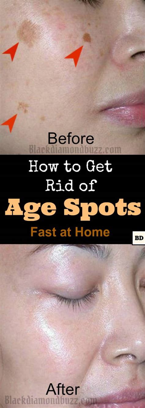 How to Get Rid of Age Spots on Face | 7 Home Remedies That Work Fast