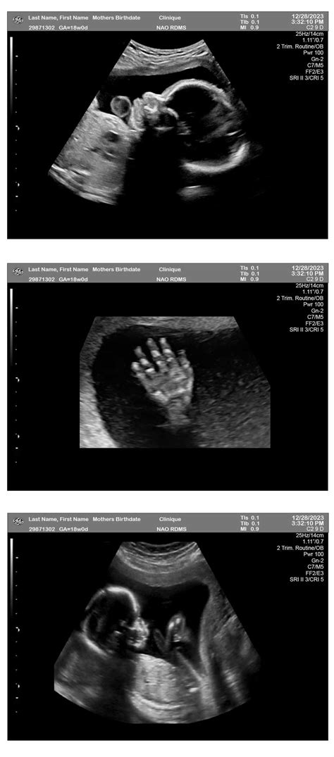 18 Week Pregnancy Ultrasound - Ultrasounds