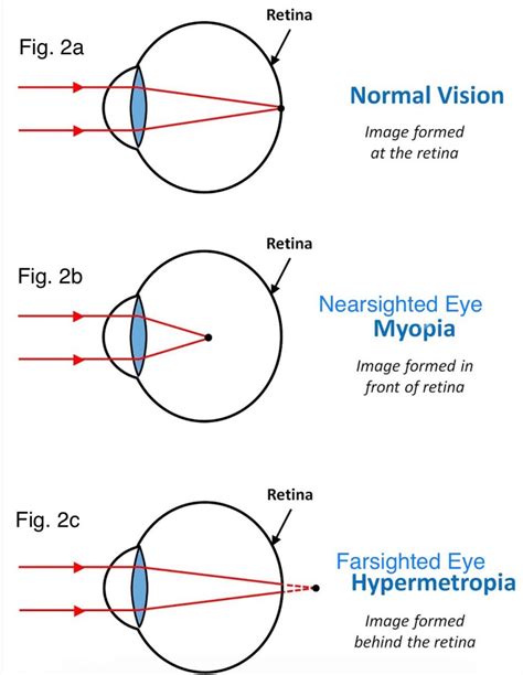 What is Presbyopia? How do I know if I have it? How can I correct it?