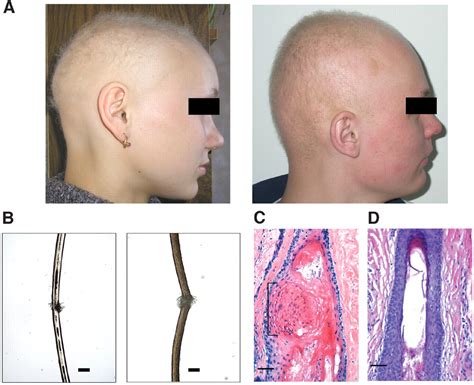 Human Hair Growth Deficiency Is Linked to a Genetic Defect in the Phospholipase Gene LIPH | Science