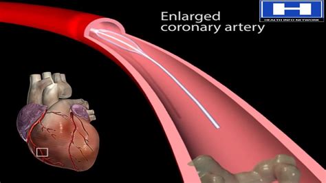 How Balloon Angioplasty is Done Animation - Coronary Angiography Procedure | Stenting in Heart ...