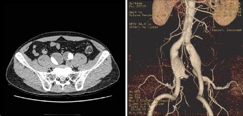 Figure 1 from Endovascular Treatment of Isolated Bilateral Common Iliac Artery Aneurysms Using ...