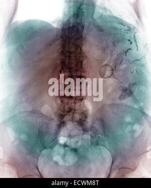 abdomen x-ray showing a vena cava blood clot filter Stock Photo - Alamy