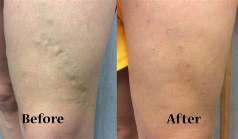 Varicose veins pictures before and after | Symptoms and pictures