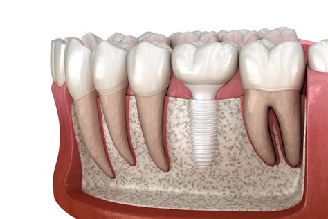 Ceramic Dental Implants in Mexico – Mexicodent