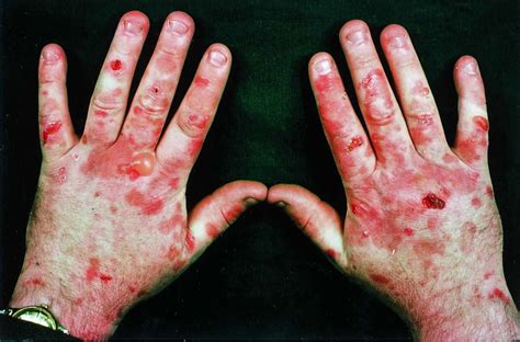 Porphyria cutaneous tarda causes, symptoms, diagnosis & treatment