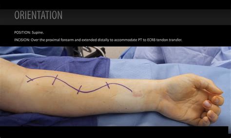 Median to Radial Nerve Transfers with PT to ECRB Tendon Transfer — OrthopaedicPrinciples.com