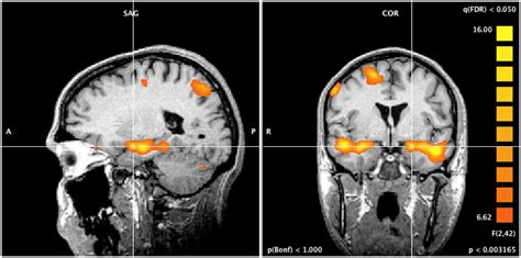 Frontiers | Amygdala responses to unpleasant pictures are influenced by task demands and ...