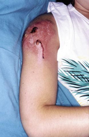 Spider bite in southern Africa: diagnosis and management | Muller | Continuing Medical Education