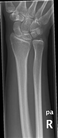 Radius Bone X Ray