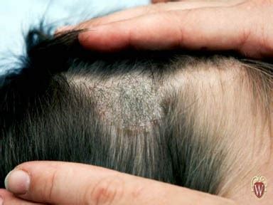 INFORMATION HUB: Fungus Infection of the Scalp (tinea Capitis)