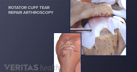 Different Types of Rotator Cuff Surgery