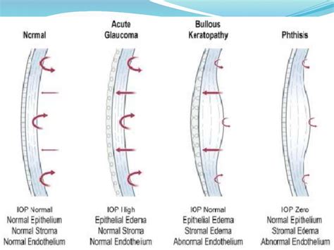 Corneal edema after cataract surgery - MALEK AL KOTT