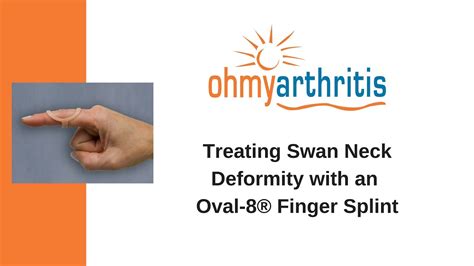 How to Treat a Swan Neck deformity with an Oval-8 Finger Splint - Oh My Arthritis - YouTube