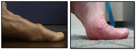 Hallux Limitus & Rigidus Sydney | Big Toe Arthritis Treatment Sydney, NSW