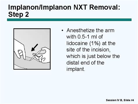 Contraceptive Implants Session IV B OneRod Implant Removal